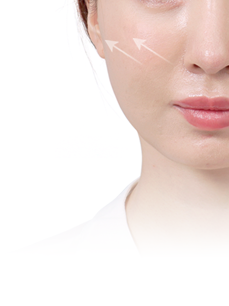 Conventional Mini Lifting Lateral lifting Cheekbones appear more pronounced Face appears wider