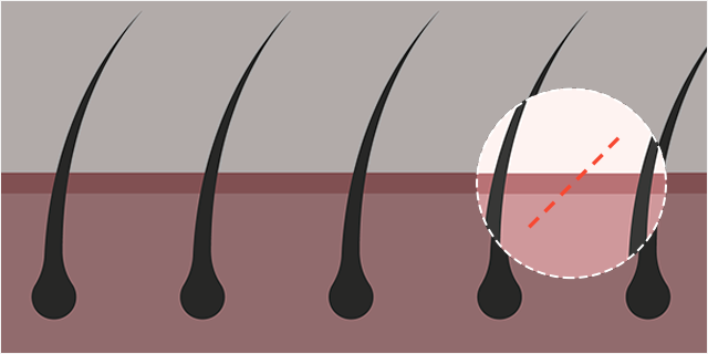 Non-visible scars Hidden scar + diagonal incision Mini Lifting Preventing hair loss with diagonal incisions made in consideration the direction of the hair roots