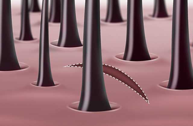 At SAYYES Clinic, we minimize the risk of hair loss by making incisions between the hair roots to prevent damage. 