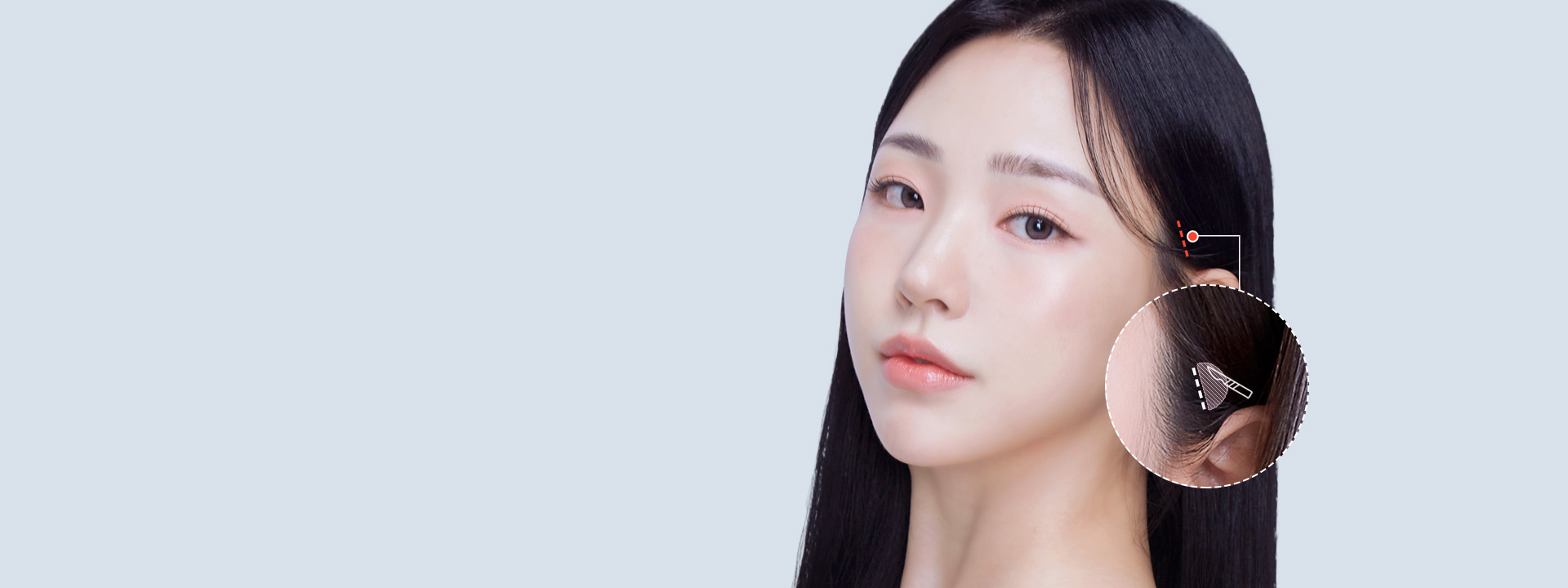 Non-visible scars Hidden scar + diagonal incision Mini Lifting Non-visible scars