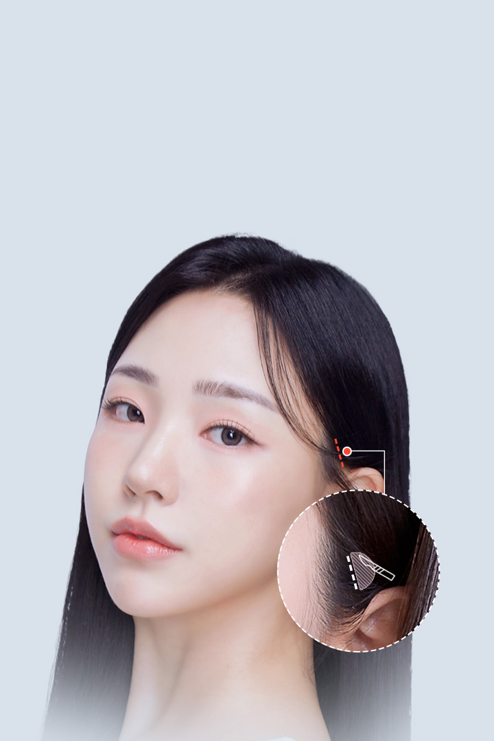 Non-visible scars Hidden scar + diagonal incision Mini Lifting Preventing hair loss with diagonal incisions made in consideration the direction of the hair roots