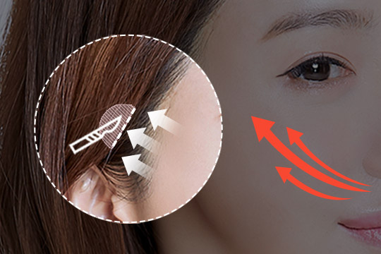 STEP 02 Sagging cheekbone area, nasolabial folds, sagging cheeks