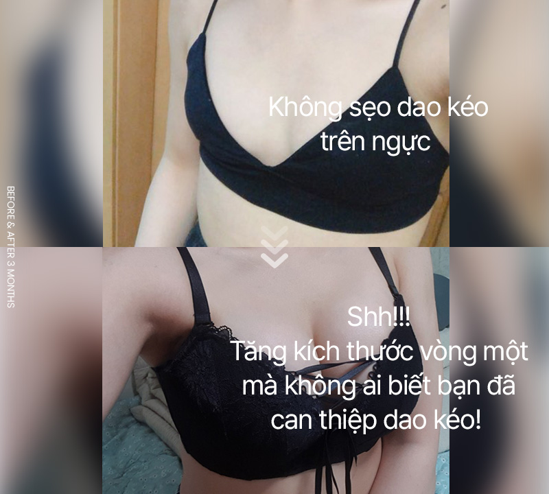 Tăng kích thước vòng một mà không ai biết bạn đã can thiệp dao kéo!