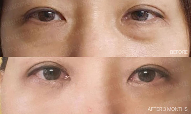 Ảnh trước và sau