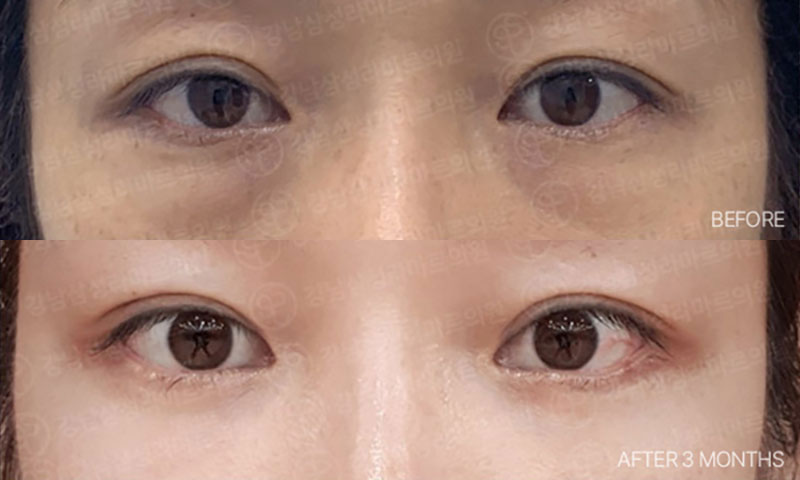 Ảnh trước và sau