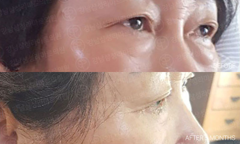 Ảnh trước và sau