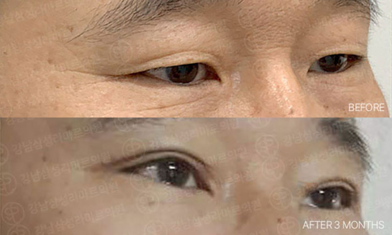 Ảnh trước và sau