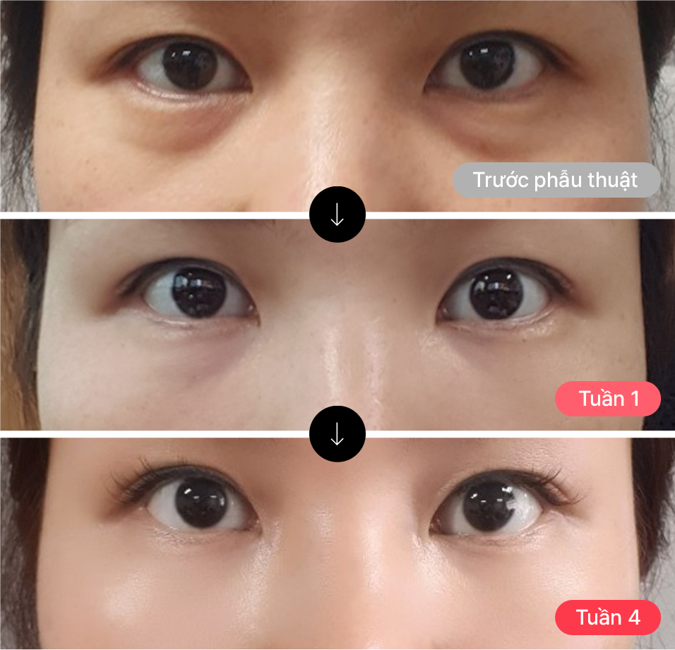 Ảnh này được chụp ngay sau khi bệnh phân phẫu thuật mí mắt tháo chỉ  Như bạn thấy, sau một thời gian, sẹo rạch mờ đi gần như không thể nhìn thấy qua quá trình hồi phục.