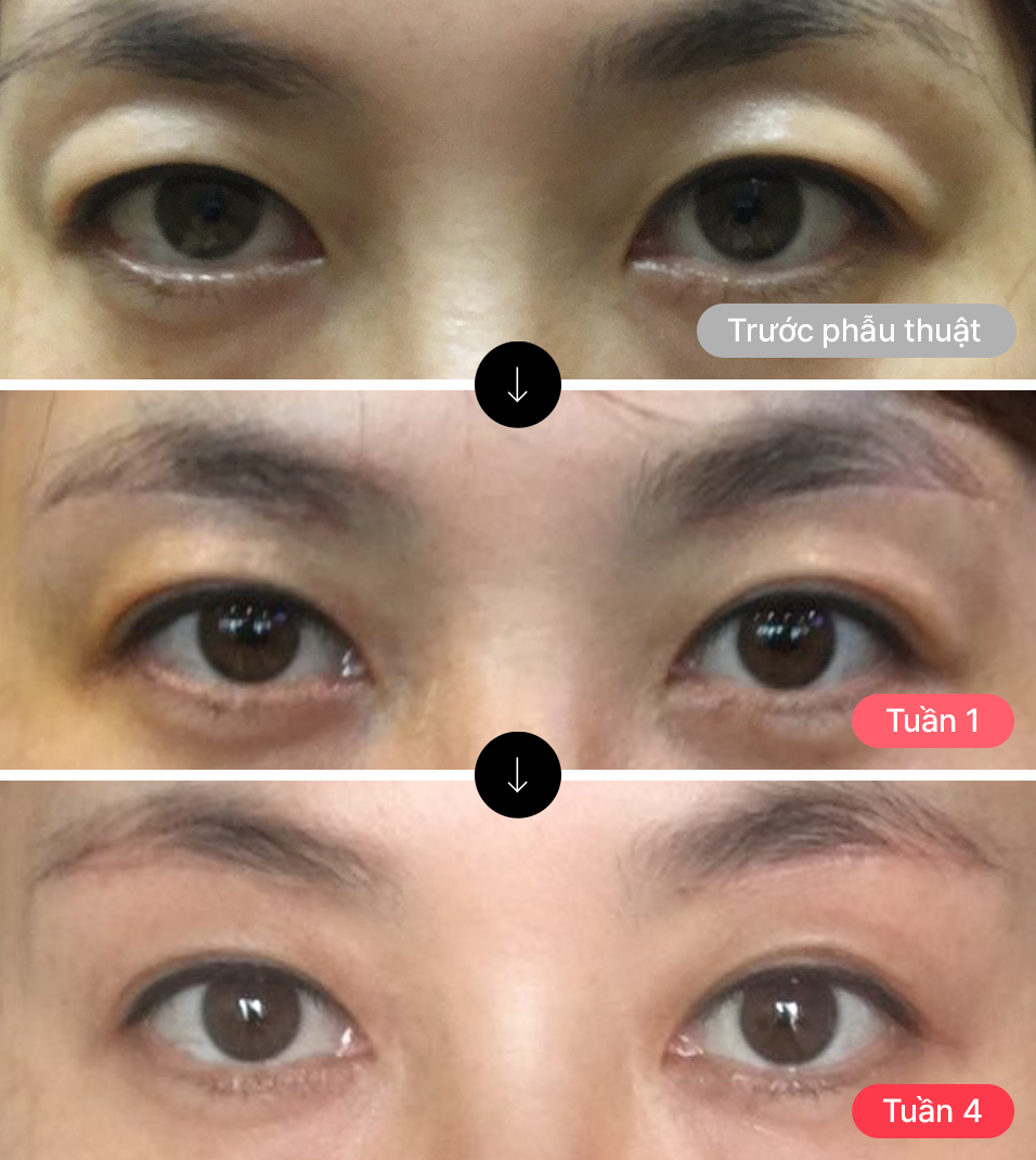 Ảnh này được chụp ngay sau khi bệnh nhân nâng chân mày tháo chỉ. Như bạn thấy, sau một thời gian, sẹo rạch mờ đi gần như không thể nhìn thấy qua quá trình hồi phục.