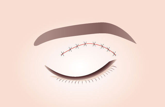 STEP 04 Khâu Vết rạch được khâu lại cẩn thận.