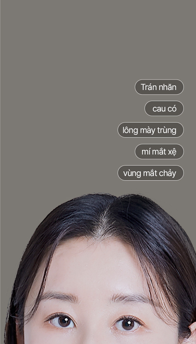 Trông mệt mỏivà có dấu hiệu tuổi tác + Mắt xệ + Lông mày trùng + Trông cau có + Trán nhăn Mọi vấn đề đều được giải quyết tức thì bằng Căng da vùng trán nội soi