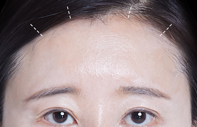 STEP 02 Rạch Chỉ một vết rạch 2 điểm bên trong tóc.