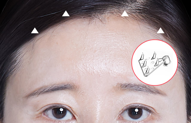 STEP 03 Phần cấy được tháo bằng phương pháp nội soi, tiếp đến trán và lông mày được kéo lên và cố định.