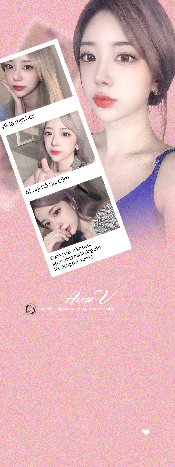 #Má mịn hơn #Loại bỏ hai cằm Đường viền hàm dưới #gọn gàng mà không cần tác động đến xương Accu V Thon gọn khuôn mặt & Hút mỡ