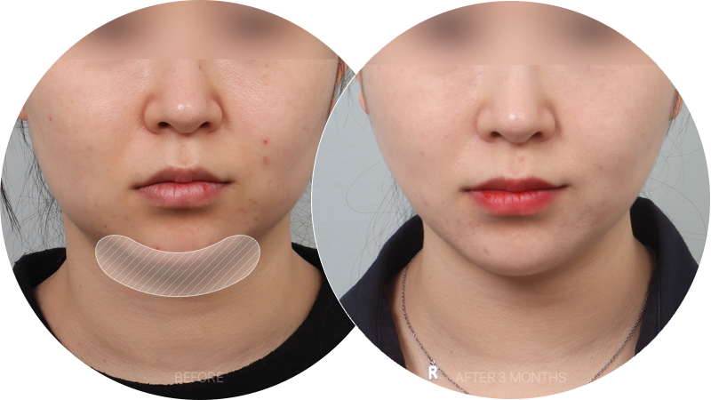 Hai cằm được xử lý vừa đủ từ góc nhìn phía trước giúp làm thon gọn khuôn mặt! Phần mỡ sâu bên trong các cơ được hút bổ sung đồng thời phần cơ ở vùng hai cằm được siết gọn!