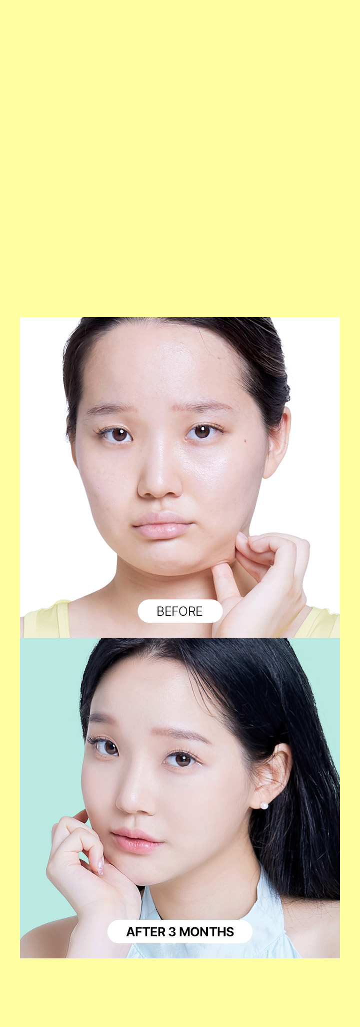 Thủ thuật hút mỡ dung tích lớn & làm thon gọn khuôn mặt Say Yes Đối với hút mỡ mặt, áp dụng các kỹ thuật đặc biệt để ngăn chặn chảy xệ và ảnh hưởng đến dây thần kinh, đồng thời hút mỡ càng nhiều càng tốt nhằm làm thon gọn khuôn mặt ở mức cao nhất.