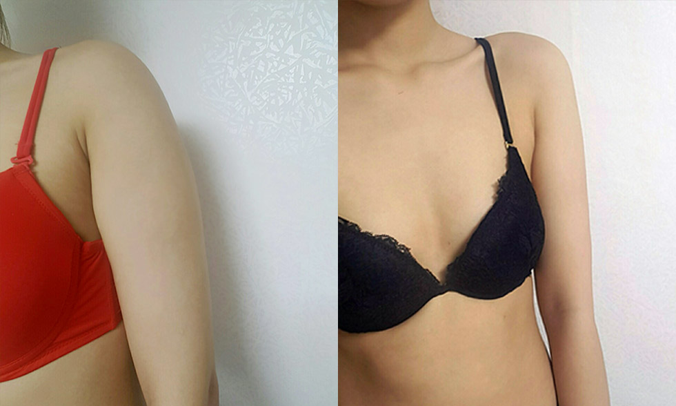 Vùng điều trị số No.1 Cánh tay sát nách Ảnh trước và sau