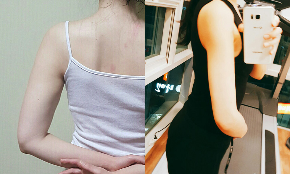 Vùng điều trị số No.1 Cánh tay sát nách Ảnh trước và sau