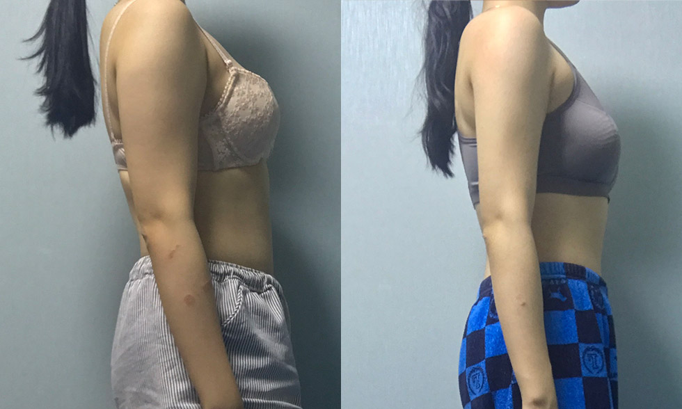 Vùng điều trị số No.1 Cánh tay sát nách Ảnh trước và sau