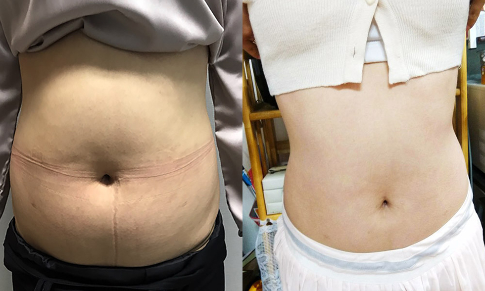 Vùng điều trị số No.3 Mỡ thừa hai eo, Bụng trên, bụng dưới Ảnh trước và sau