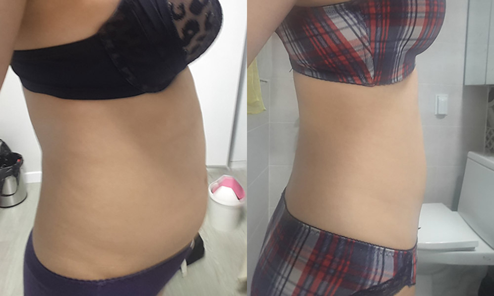 Vùng điều trị số No.3 Mỡ thừa hai eo, Bụng trên, bụng dưới Ảnh trước và sau