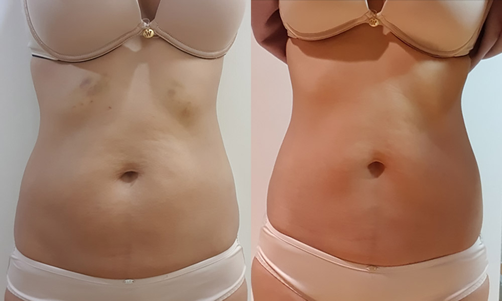 Vùng điều trị số No.3 Mỡ thừa hai eo, Bụng trên, bụng dưới Ảnh trước và sau