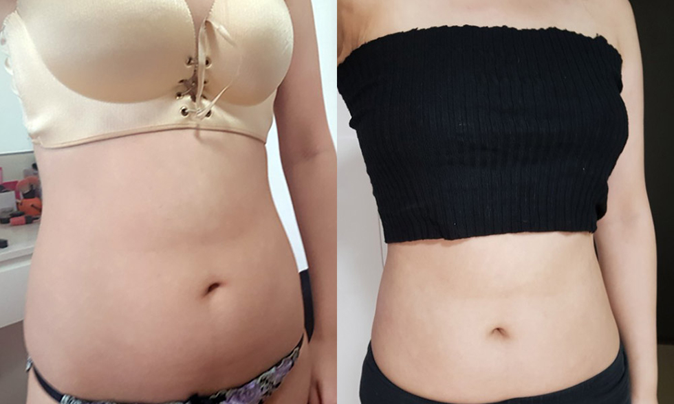 Vùng điều trị số No.3 Mỡ thừa hai eo, Bụng trên, bụng dưới Ảnh trước và sau