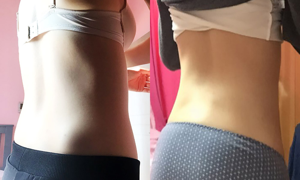 Vùng điều trị số No.3 Mỡ thừa hai eo, Bụng trên, bụng dưới Ảnh trước và sau