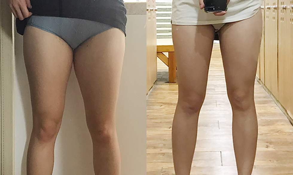 Vùng điều trị số No.4 Cơ đùi ngoài Ảnh trước và sau