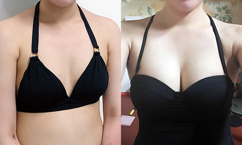 Nếu không muốn bỏ phí phần mỡ được hút bạn có thể chọn bơm phần mỡ đó   vào ngực để tạo hình giọt nước FatBra Ảnh trước và sau
