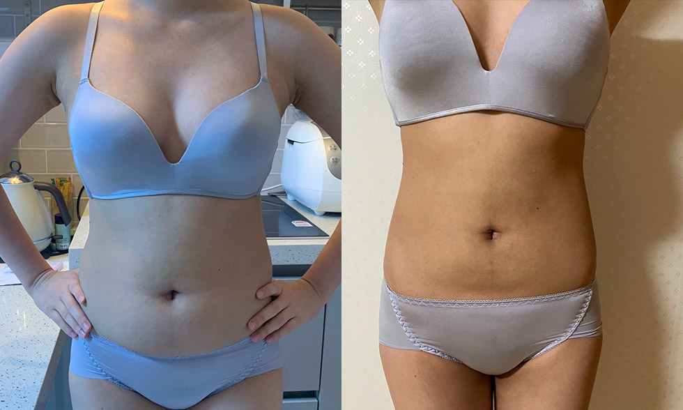 Tất cả trong một! Rút tối đa 4.000 cc mỡ từ vùng mong muốn Mega Look Fat Ảnh trước và sau