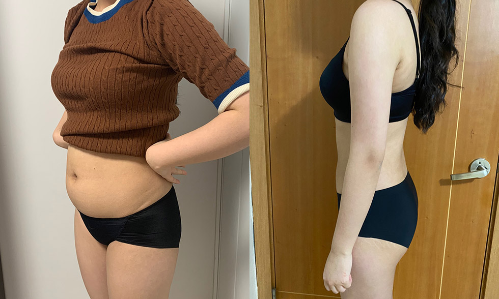 Tất cả trong một! Rút tối đa 4.000 cc mỡ từ vùng mong muốn Mega Look Fat Ảnh trước và sau