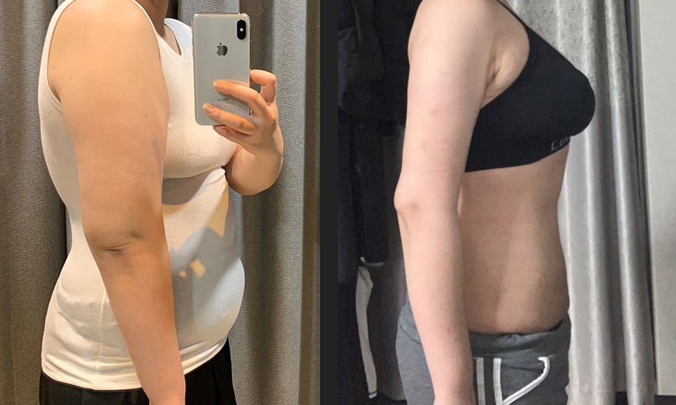 Tất cả trong một! Rút tối đa 4.000 cc mỡ từ vùng mong muốn Mega Look Fat Ảnh trước và sau