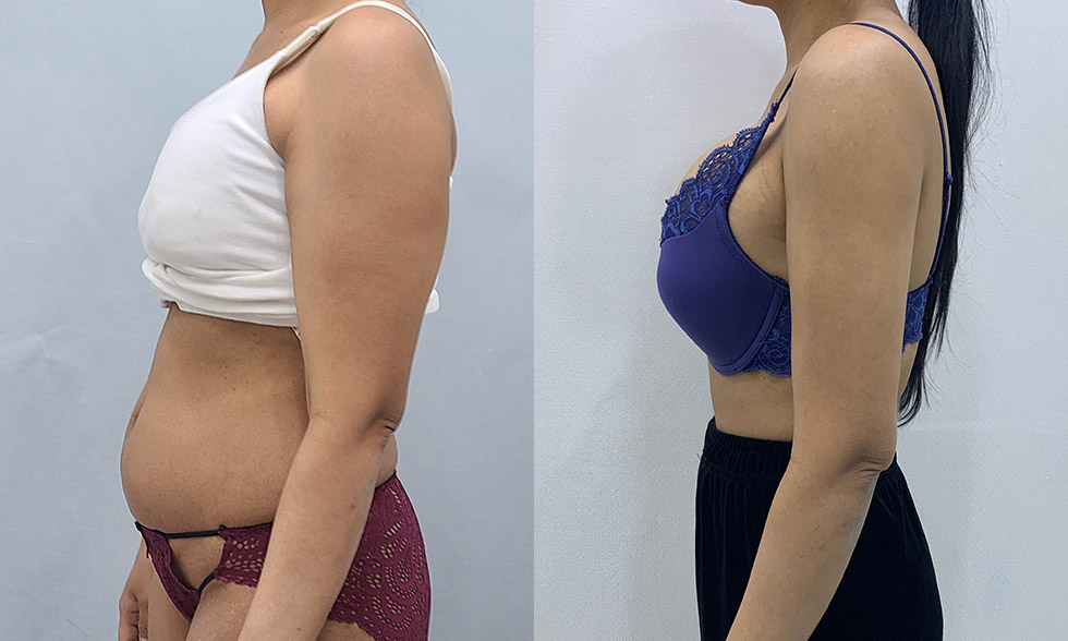Tất cả trong một! Rút tối đa 4.000 cc mỡ từ vùng mong muốn Mega Look Fat Ảnh trước và sau