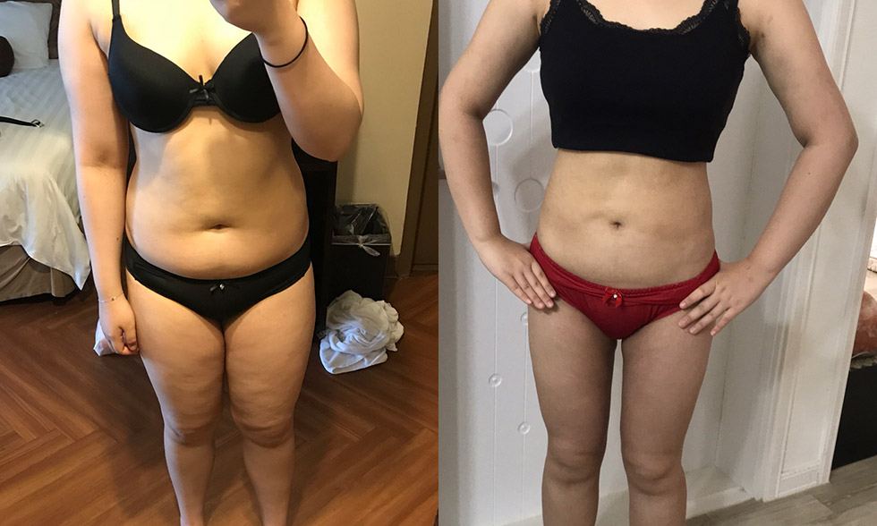 Tất cả trong một! Rút tối đa 4.000 cc mỡ từ vùng mong muốn Mega Look Fat Ảnh trước và sau