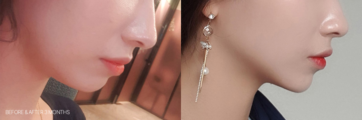 Căng da bằng laze: Ảnh trước và sau