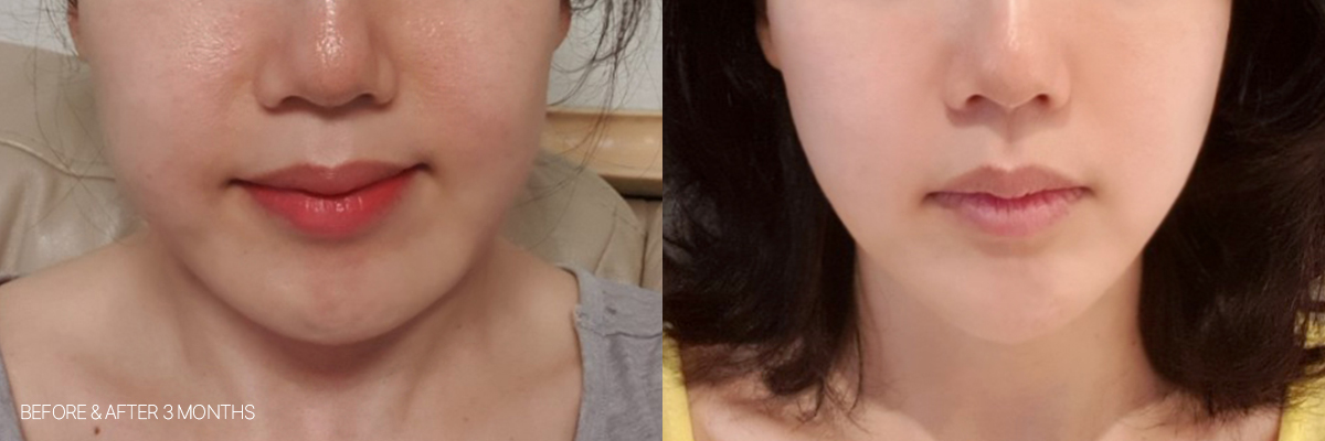 Căng da bằng laze: Ảnh trước và sau