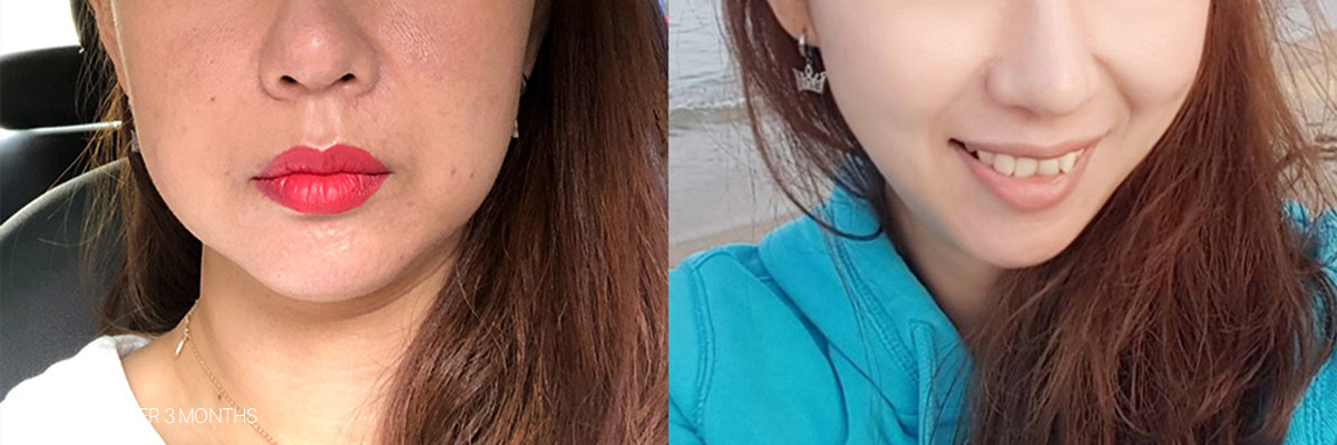 Trường hợp thực tế điều trị bằng ONDA Lifting