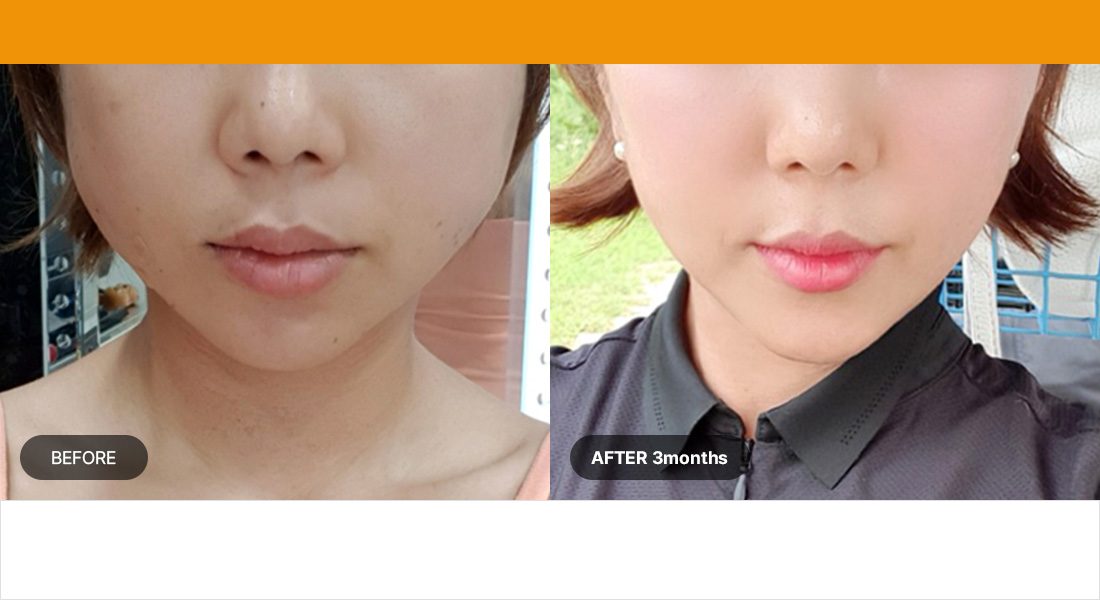 Số lần bơm hút : 300 lần / Nhóm tuổi : 20 tuổi đến đầu 30 tuổi Cải thiện các rãnh mũi má và đường viền hàm dưới bị chảy xệ, làm hẹp các lỗ chân lông, loại bỏ hóp má. Đầu dò 1,5 mm 100 lần + 4.5mm 200 lần