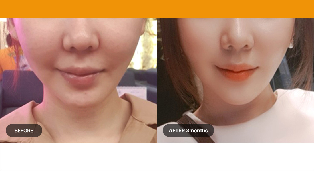 Số lần bơm hút : 500lần / Nhóm tuổi : Giữa 30 tuổi đến cuối 40 tuổi Đầu dò 1,5 mm 100 lần + 3.0mm 150lần + 4.5mm 250lần