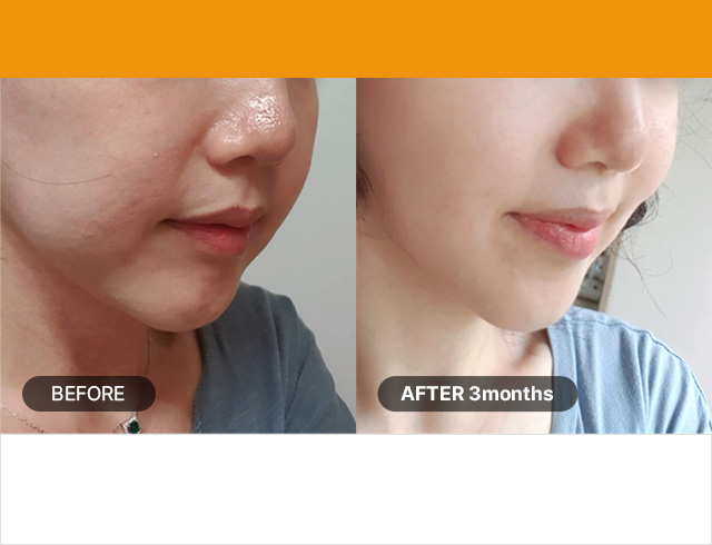 Số lần bơm hút : 500lần / Nhóm tuổi : Giữa 30 tuổi đến cuối 40 tuổi Loại bỏ mí mắt trùng, nếp nhăn dưới mắt, đường viền hàm dưới chảy xệ, rãnh mũi má và làm hẹp lỗ chân lông 1.5mm Đầu dò nhỏ/thông thường 50lần/100 lần + 3.0mm 150lần + 4.5mm 200 lần