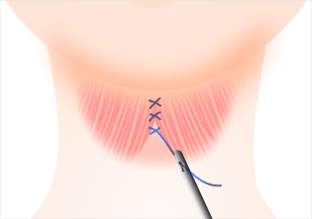 STEP 04 Phần cơ vùng cổ này được siết căng.