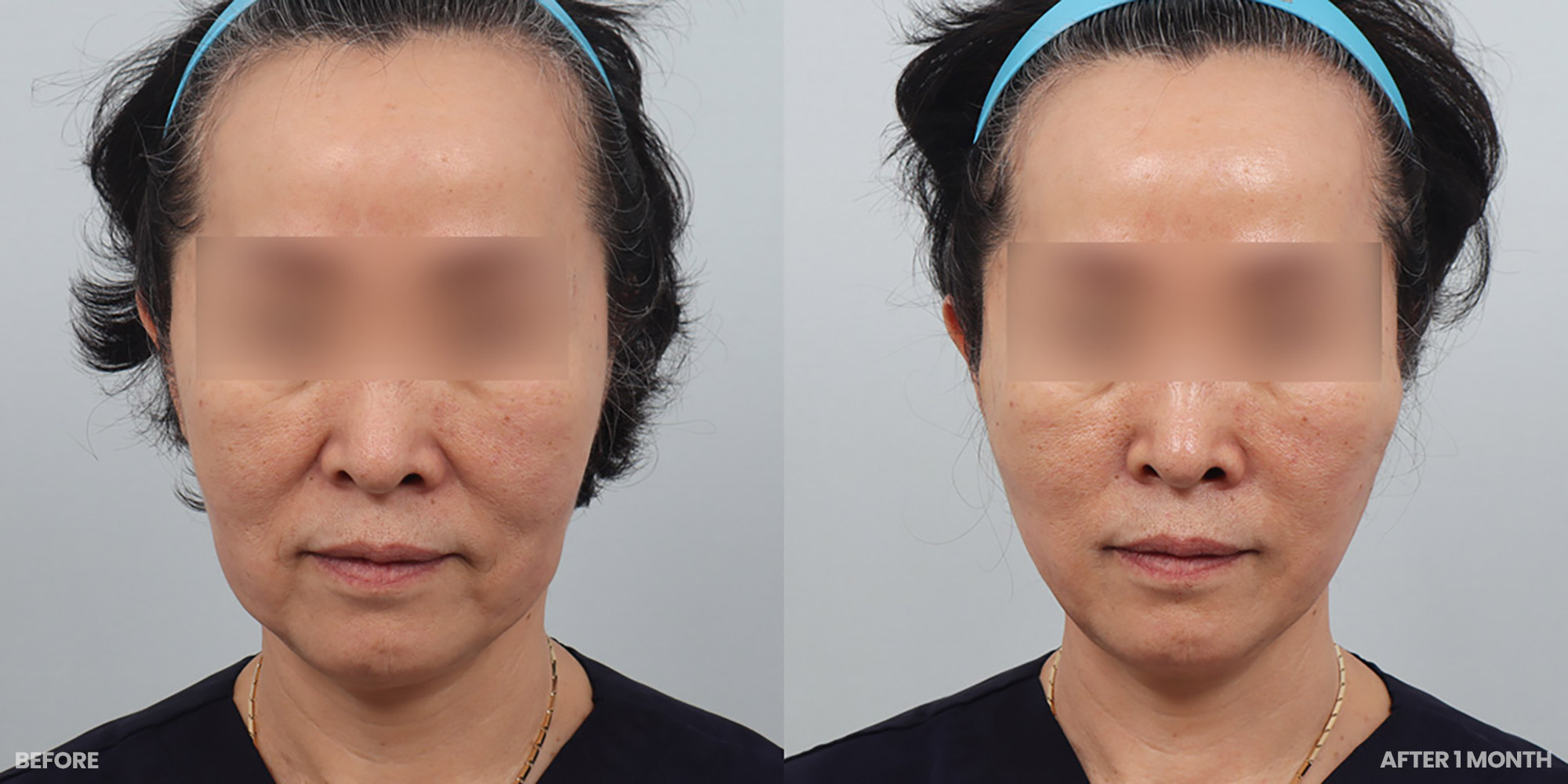 Hình ảnh trước và sau