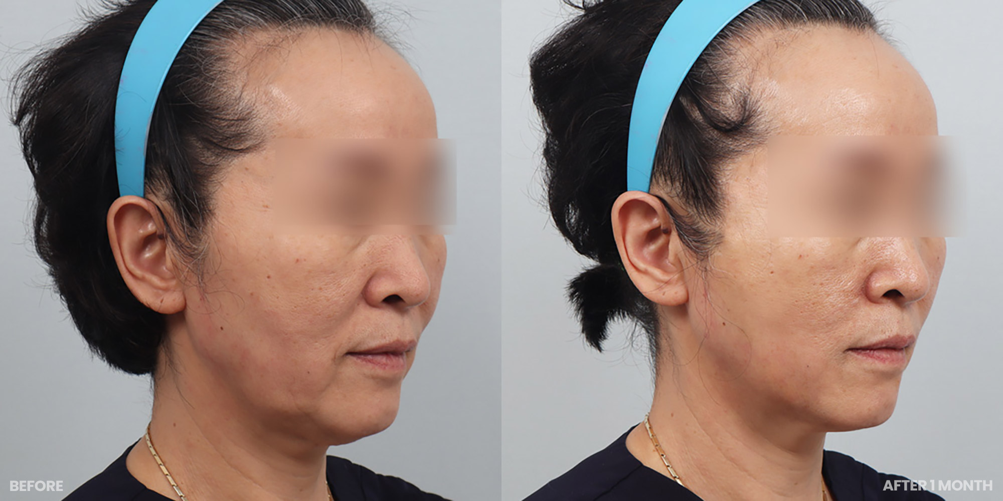 Hình ảnh trước và sau