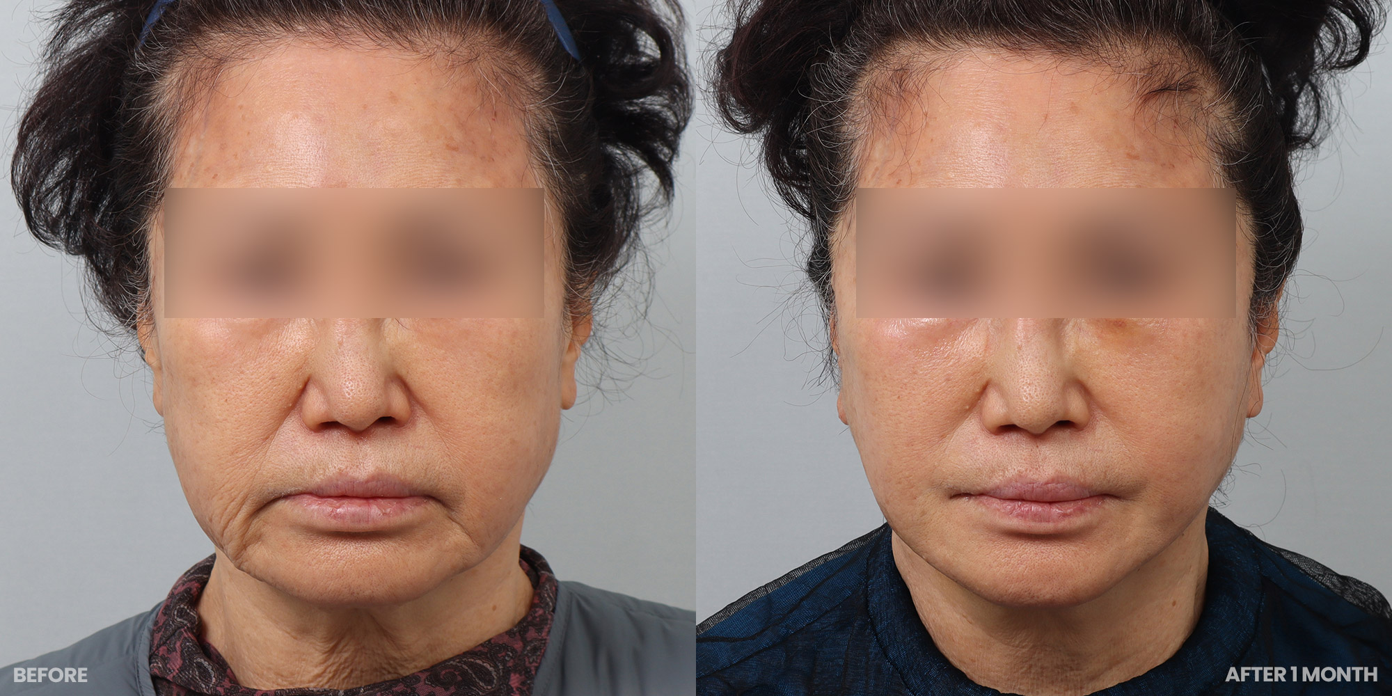 Hình ảnh trước và sau