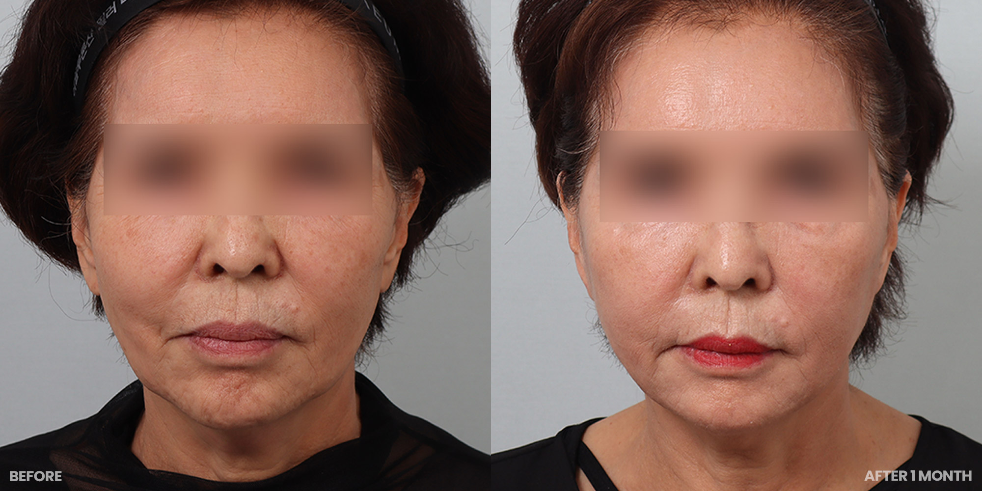 Hình ảnh trước và sau