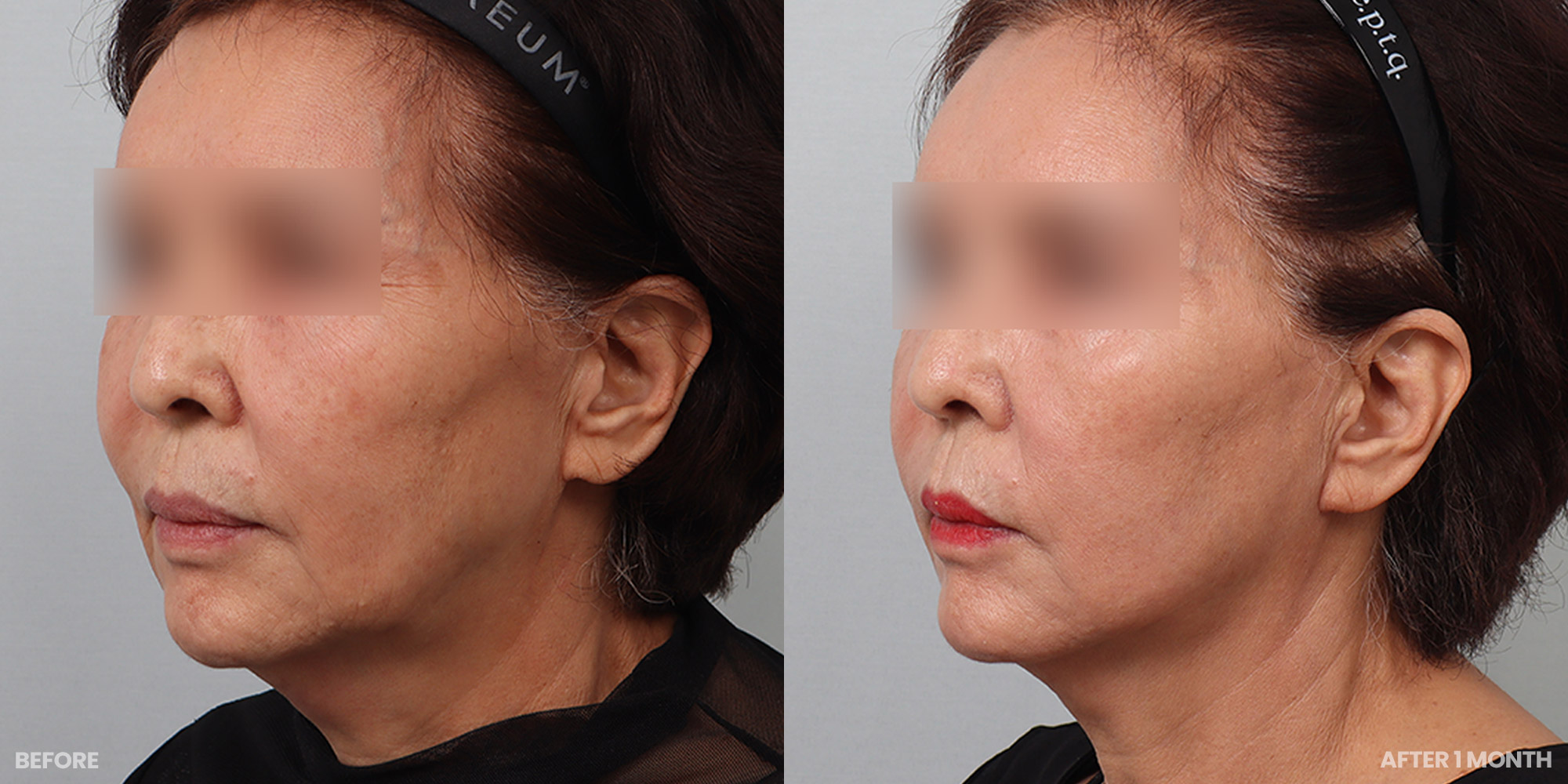 Hình ảnh trước và sau