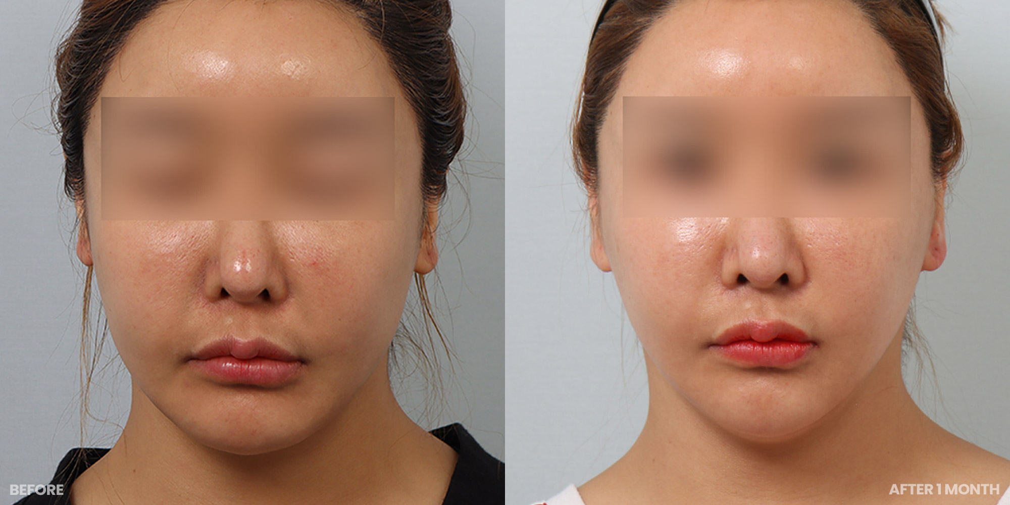 Hình ảnh trước và sau