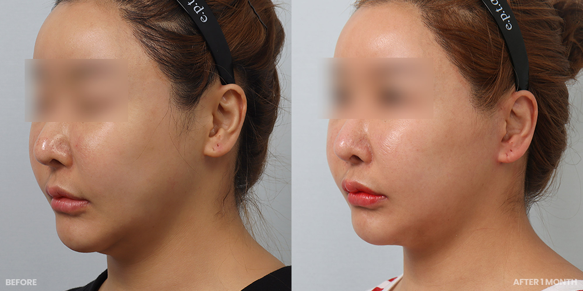 Hình ảnh trước và sau
