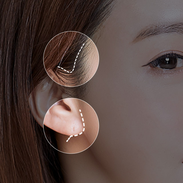 Vết rạch mini dọc theo dái tai hoặc chân tóc